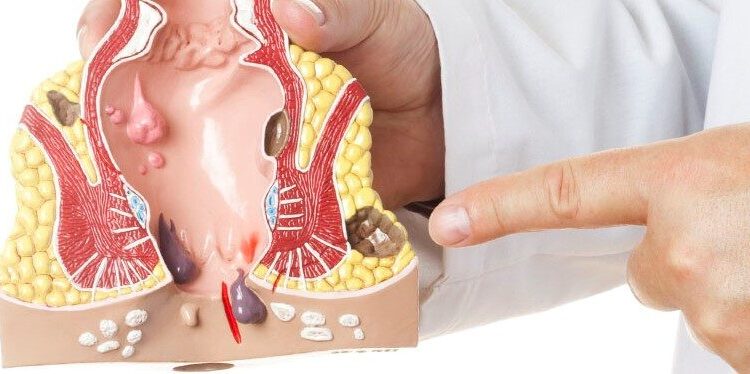 Implementan campaña de concientización frente al cáncer de recto y colon en la isla de San Andrés