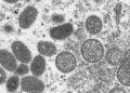 OMS declara emergencia sanitaria mundial por brote de viruela del mono  